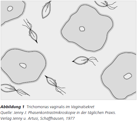 Abbildung 1 Trichomonas vaginalis im Vaginalsekret Quelle: Jenny J: Phasenkontrastmikroskopie in der täglichen Praxis. Verlag Jenny u. Artusi, Schaffhausen, 1977